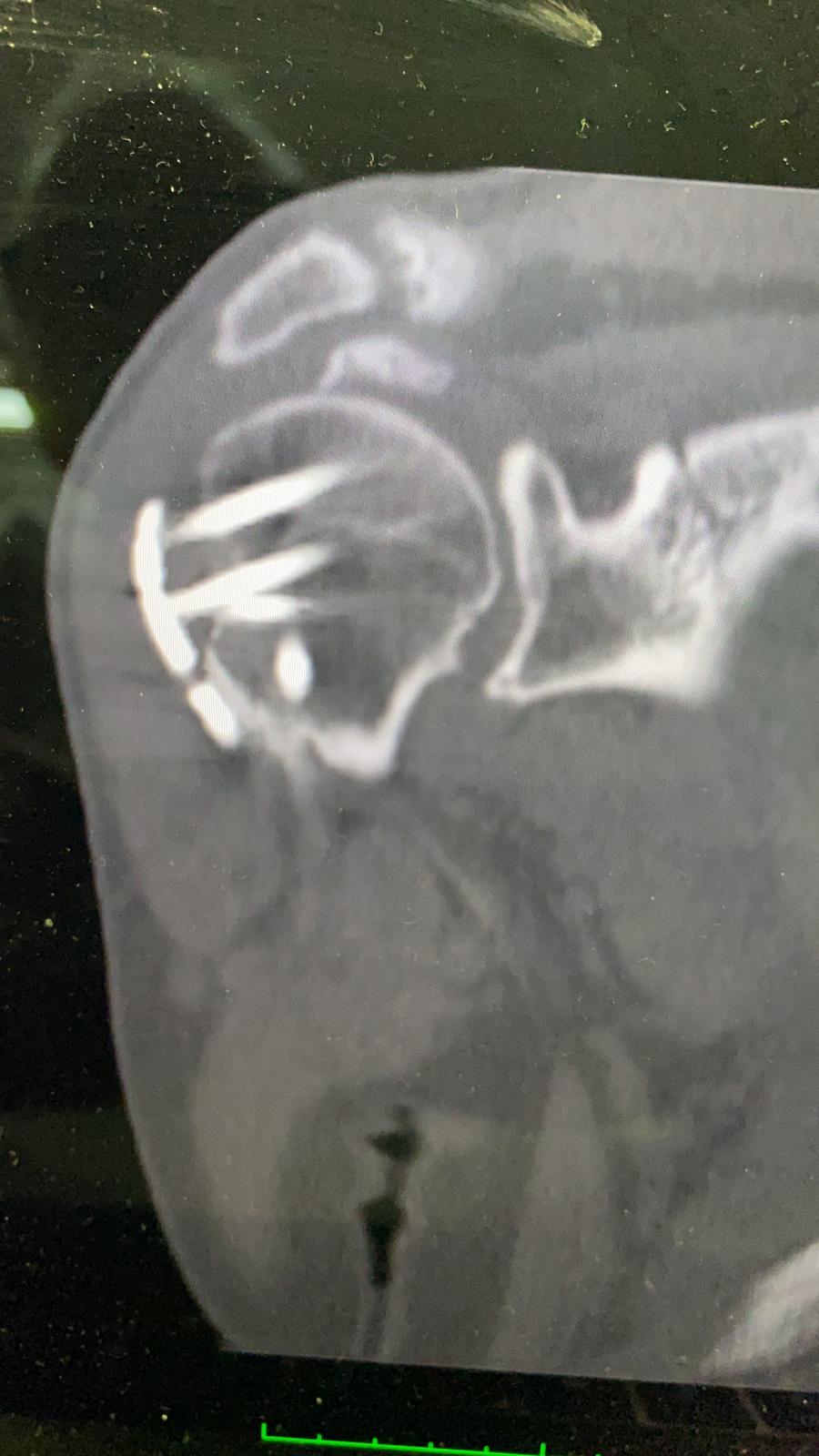 radiografia frattura dislocazione trochite