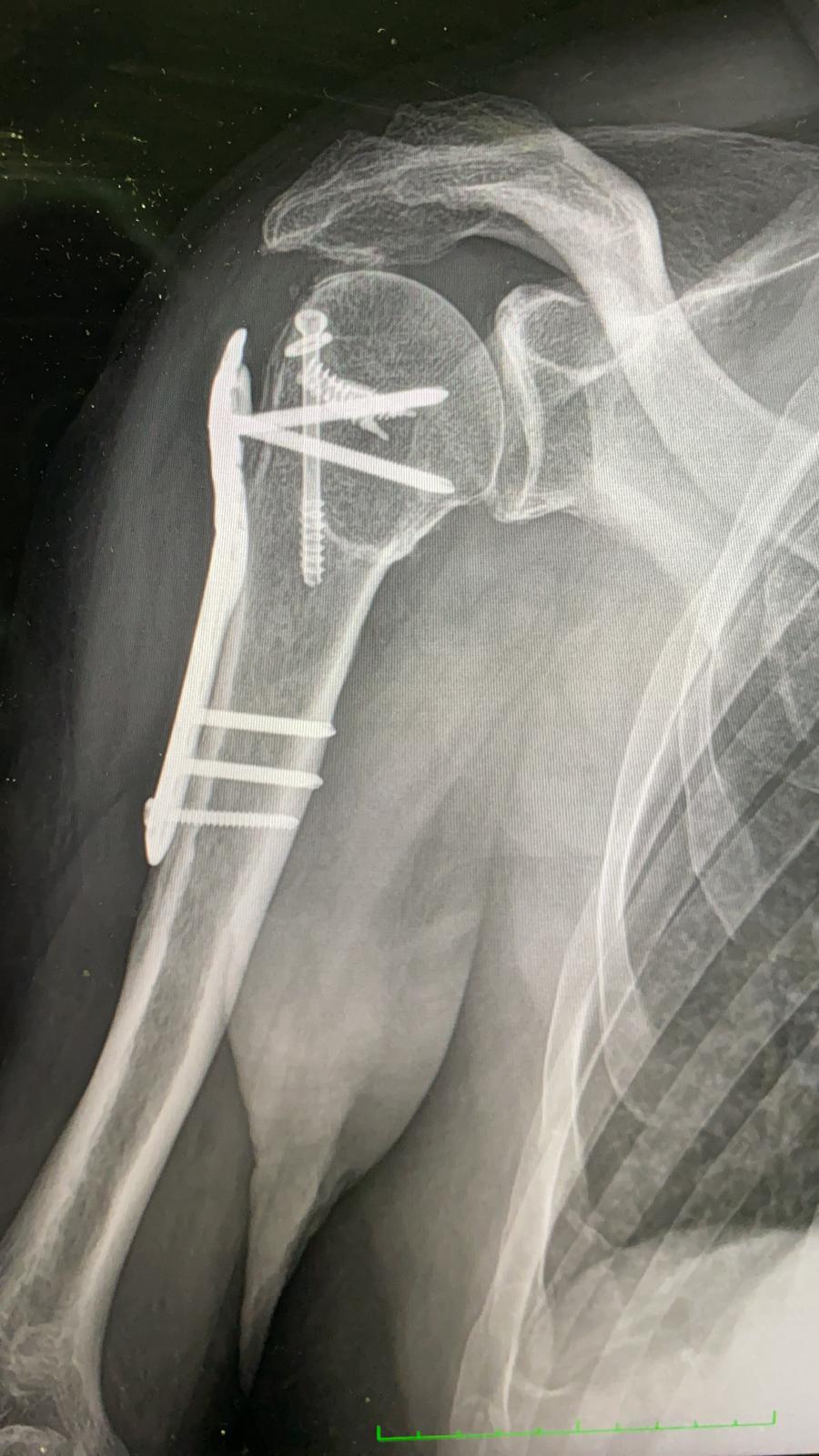 radiografia frattura dislocazione trochite 