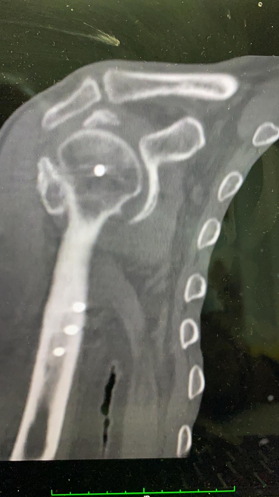 radiografie frattura dislocazione trochite